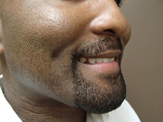 Timeless Dimple (Dimpleplasty) After