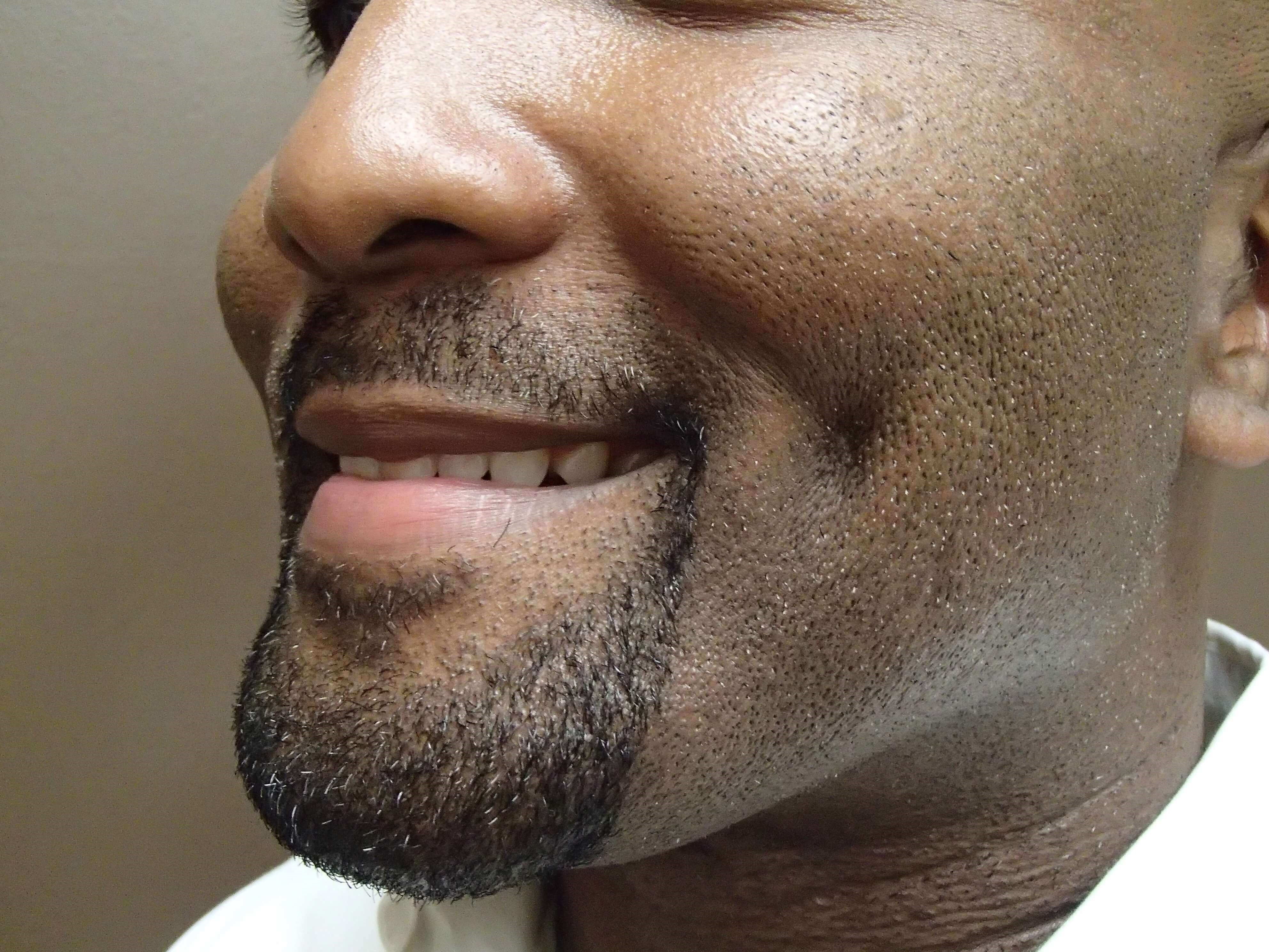 Timeless Dimple (Dimpleplasty) After