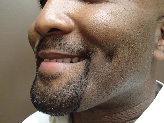 Timeless Dimple (Dimpleplasty) After
