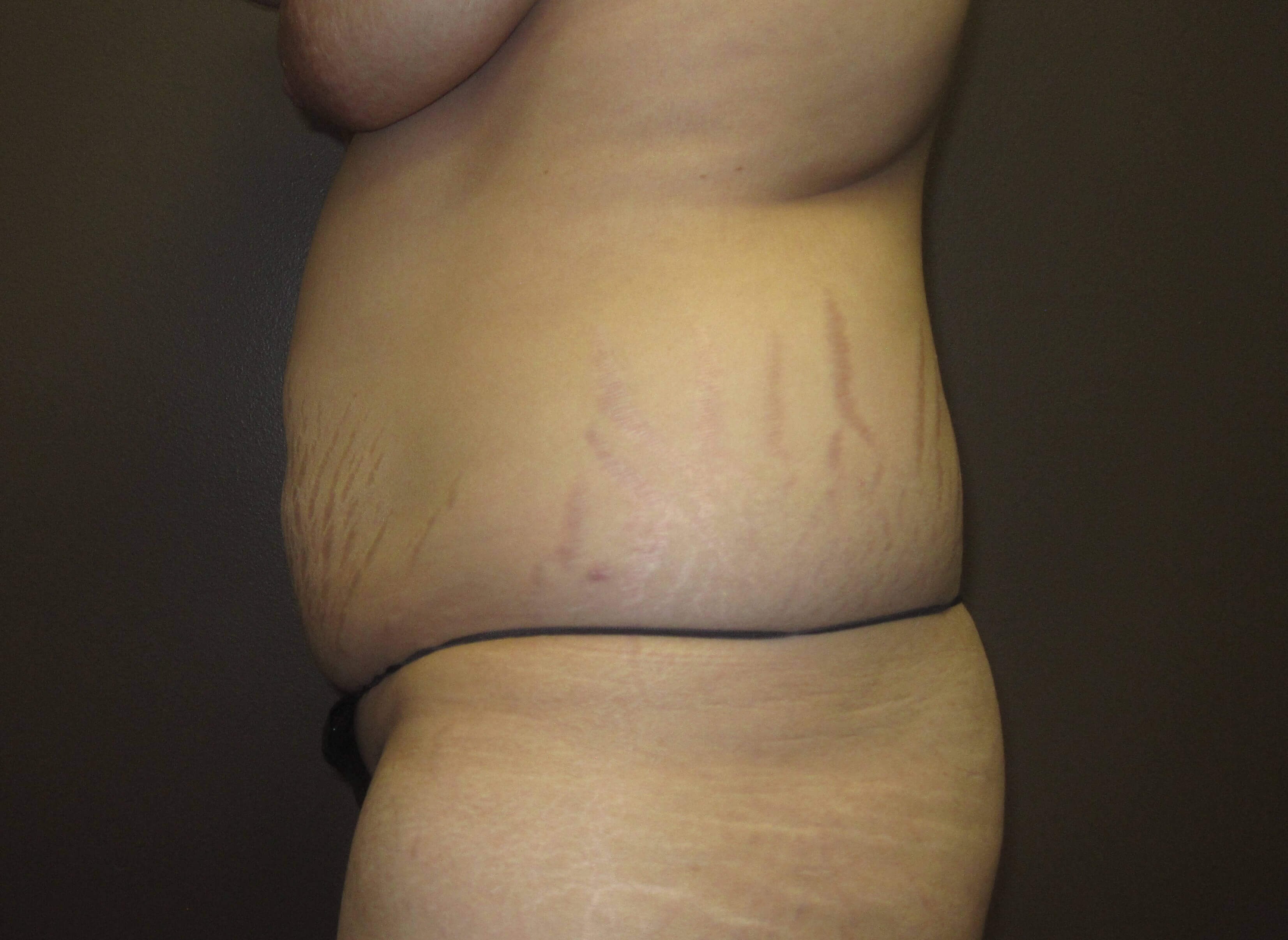 Liposuction Before