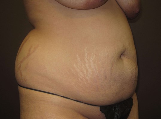 Liposuction Before