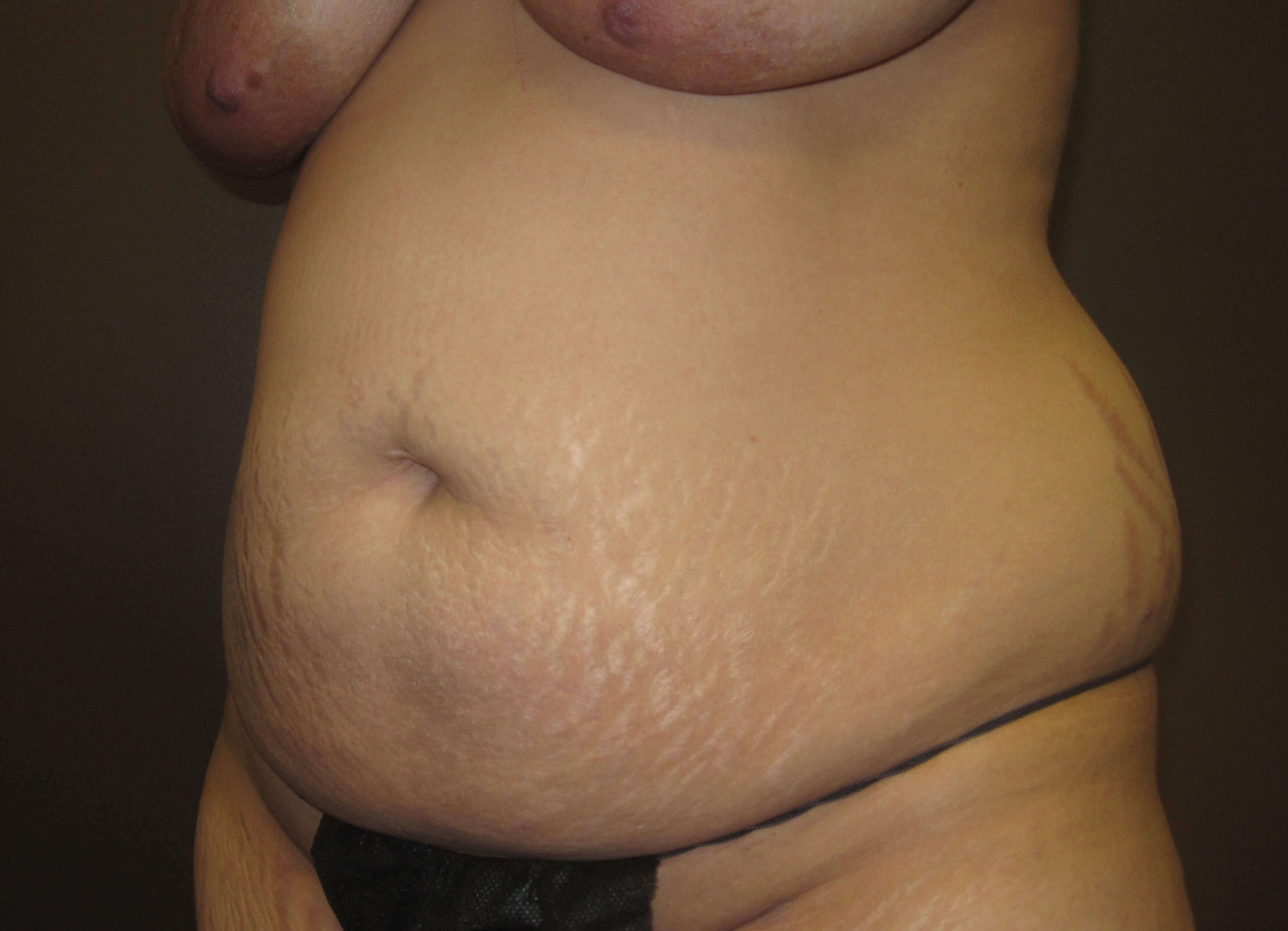 Liposuction Before