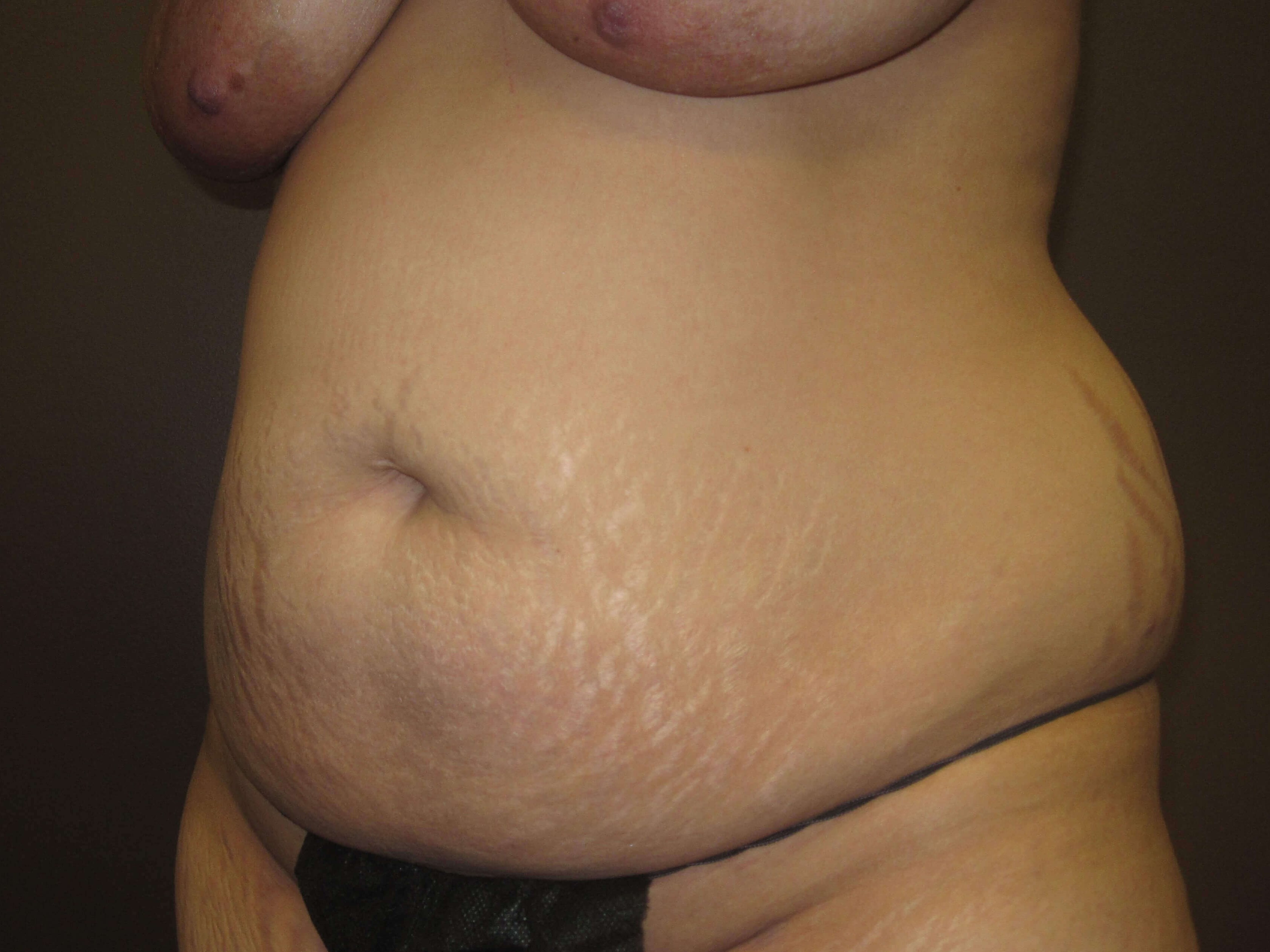 Liposuction Before