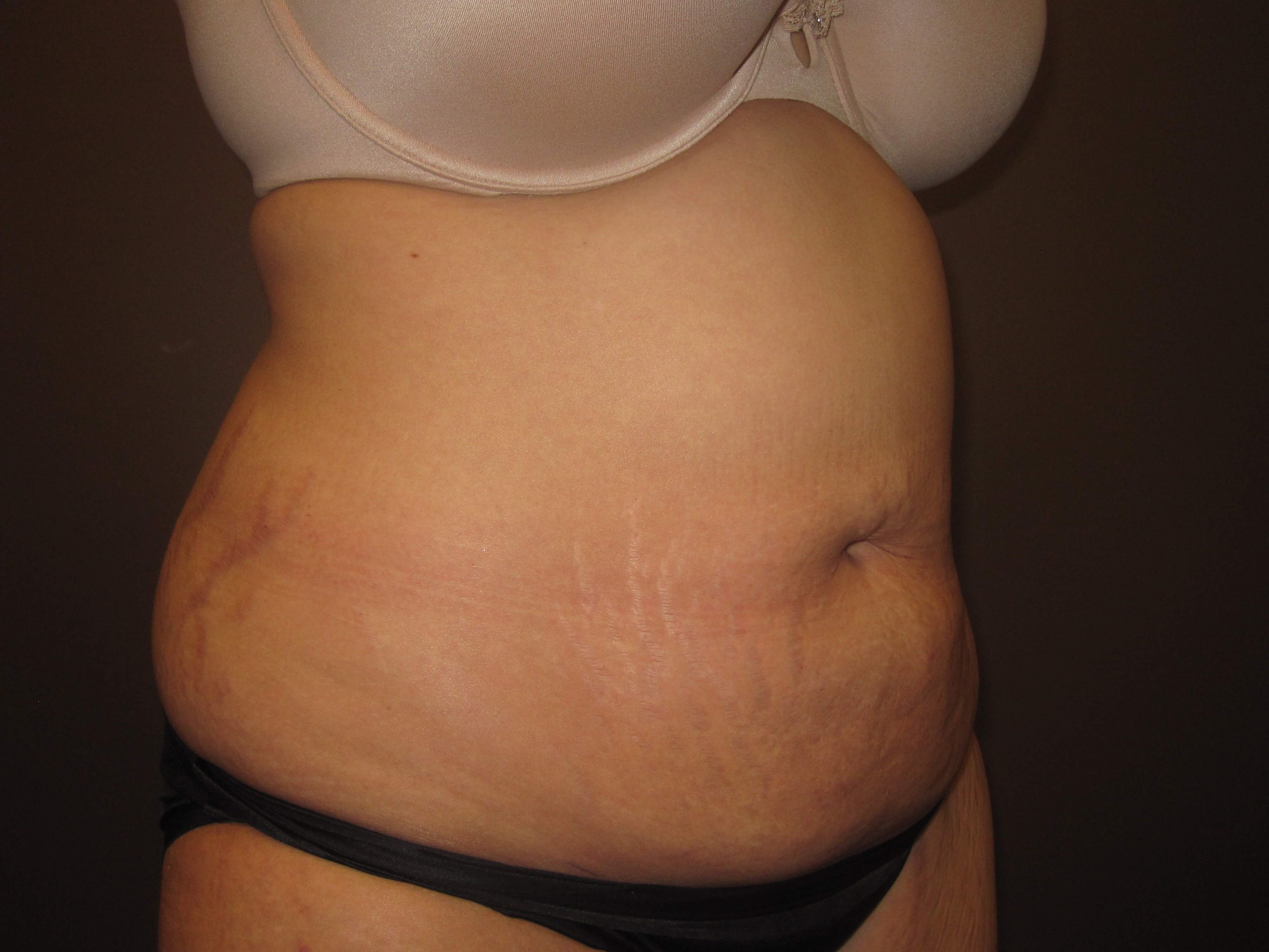 Liposuction After