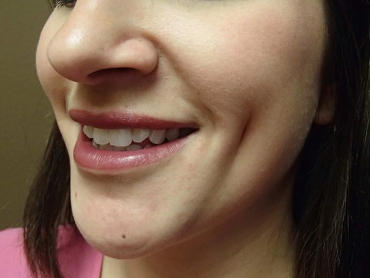 Timeless Dimple (Dimpleplasty) After