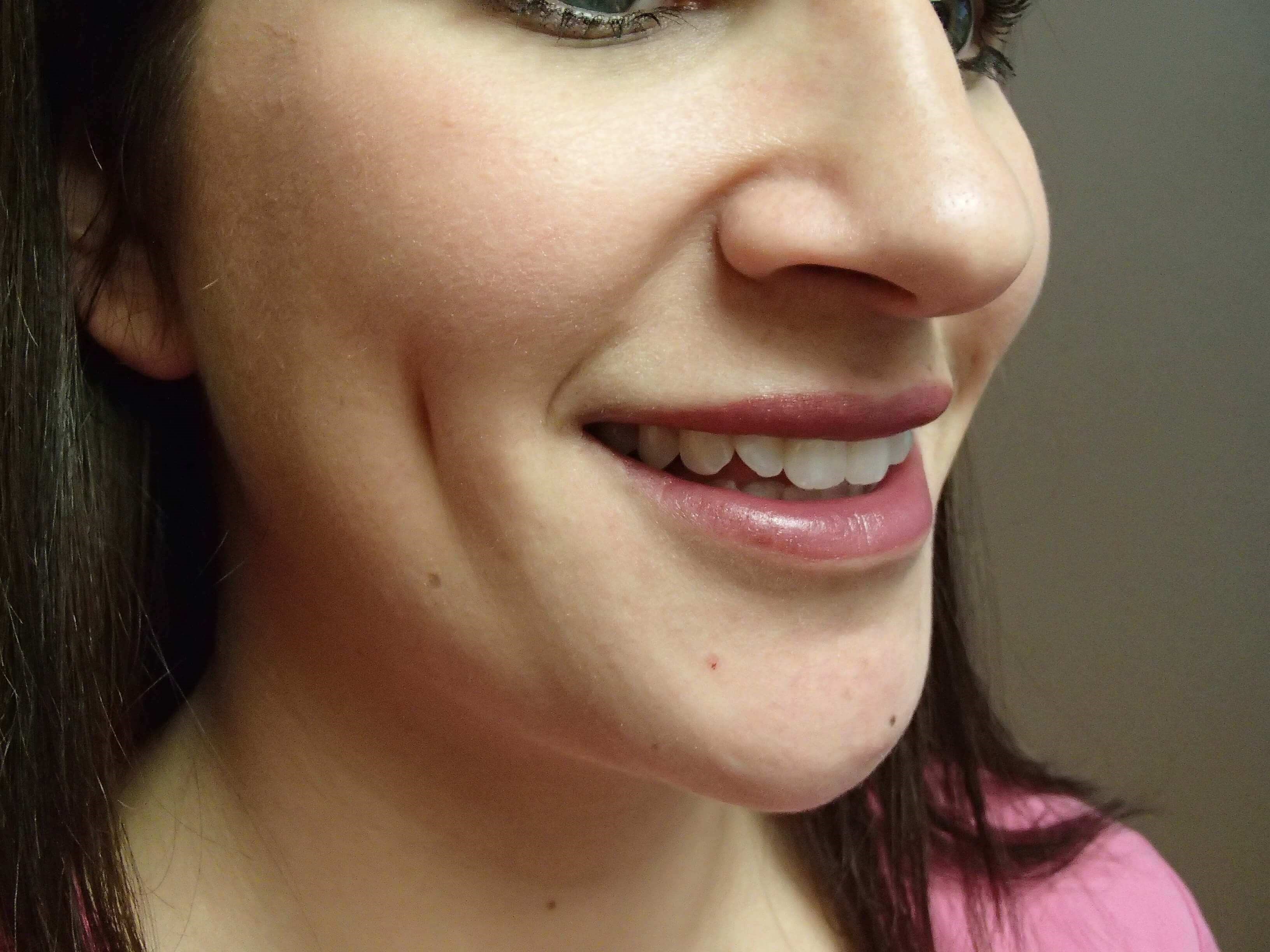 Timeless Dimple (Dimpleplasty) After