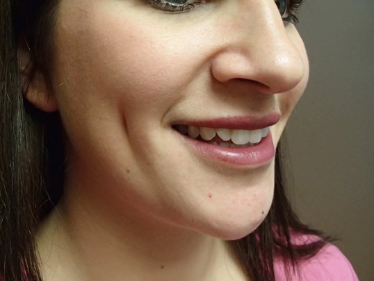 Timeless Dimple (Dimpleplasty) After