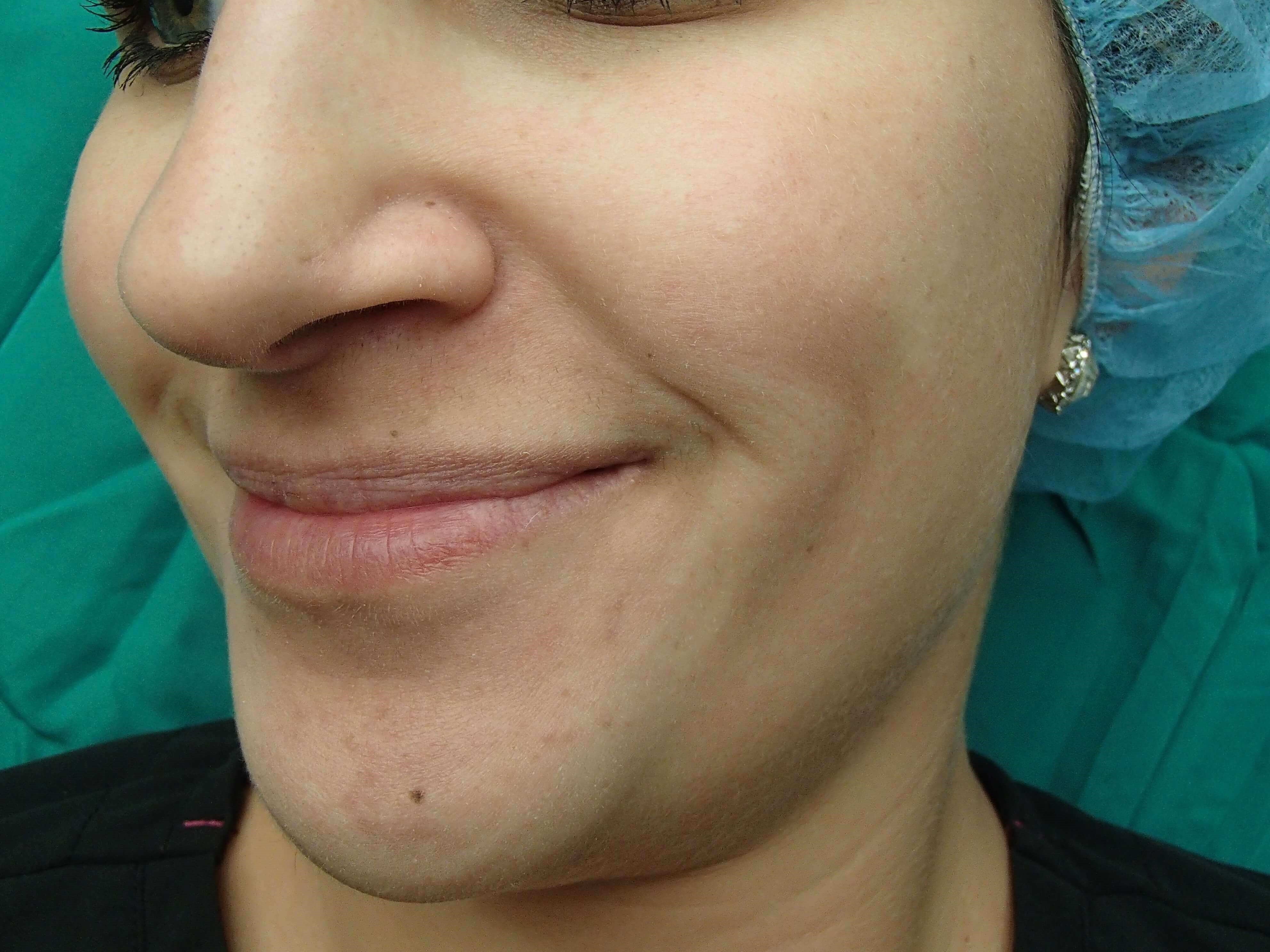 Timeless Dimple (Dimpleplasty) Before