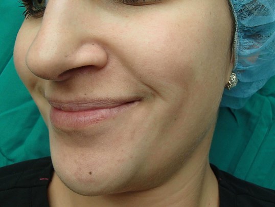 Timeless Dimple (Dimpleplasty) Before