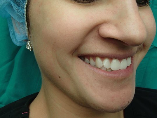 Timeless Dimple (Dimpleplasty) Before