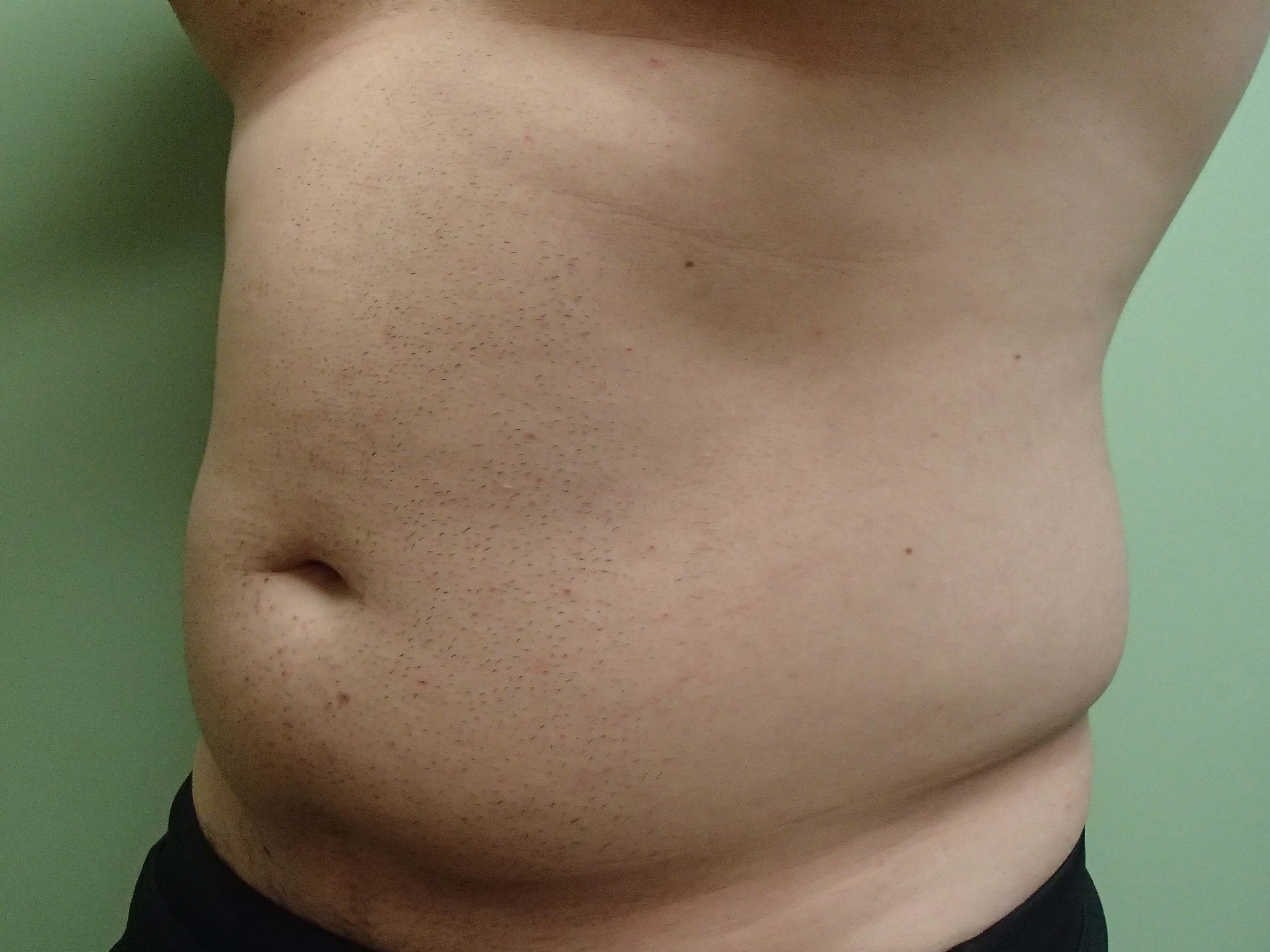 Liposuction Before