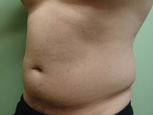 Liposuction Before