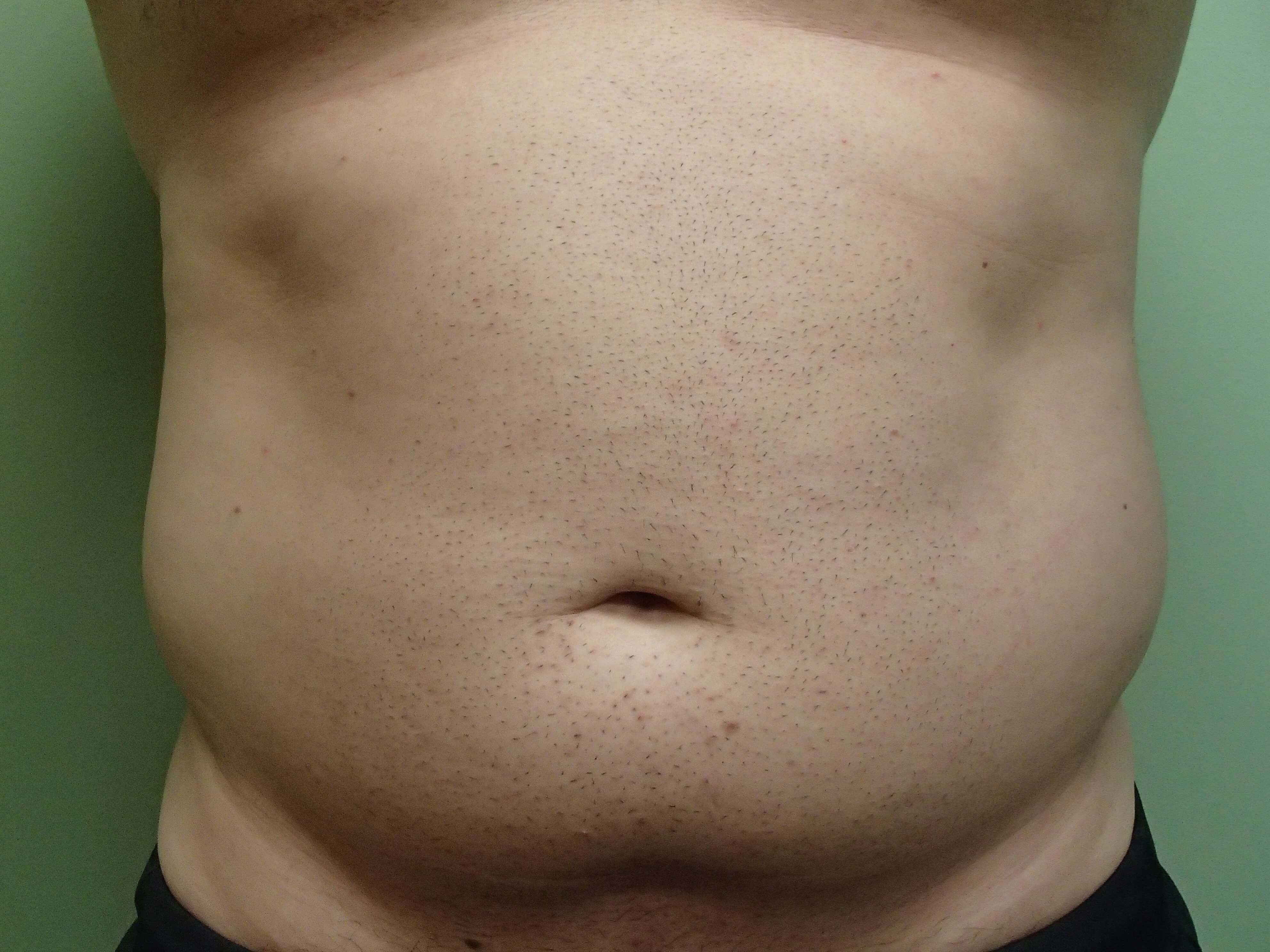 Liposuction Before
