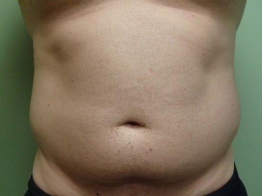 Liposuction Before