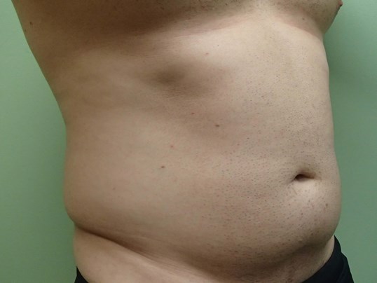 Liposuction Before