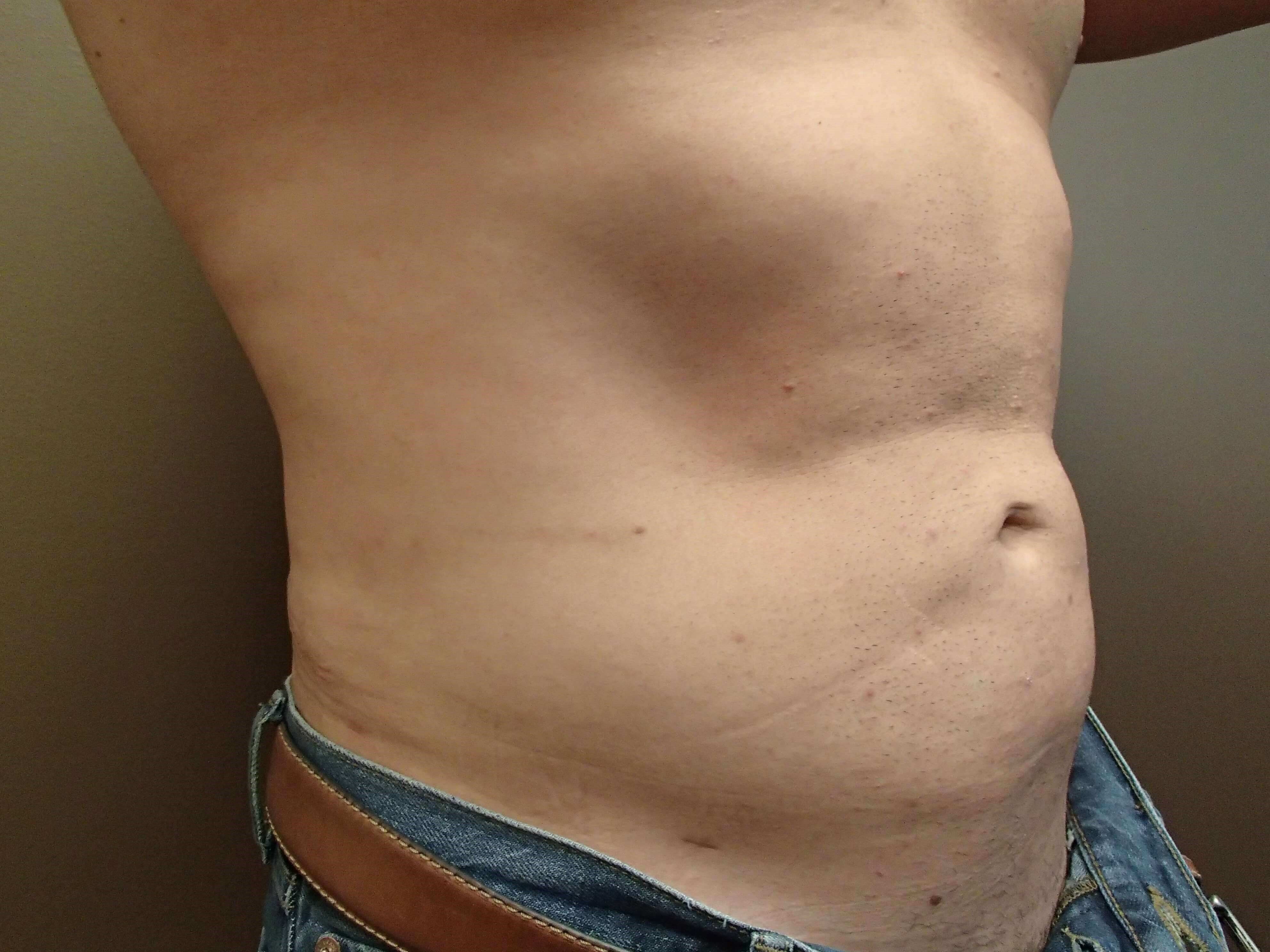 Liposuction After