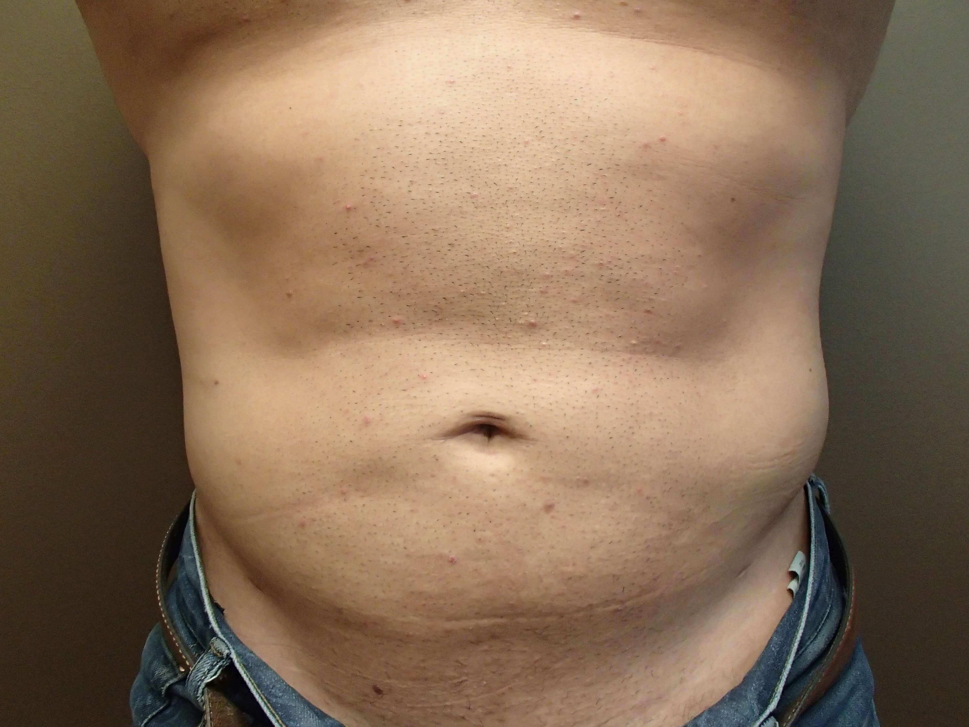 Liposuction After