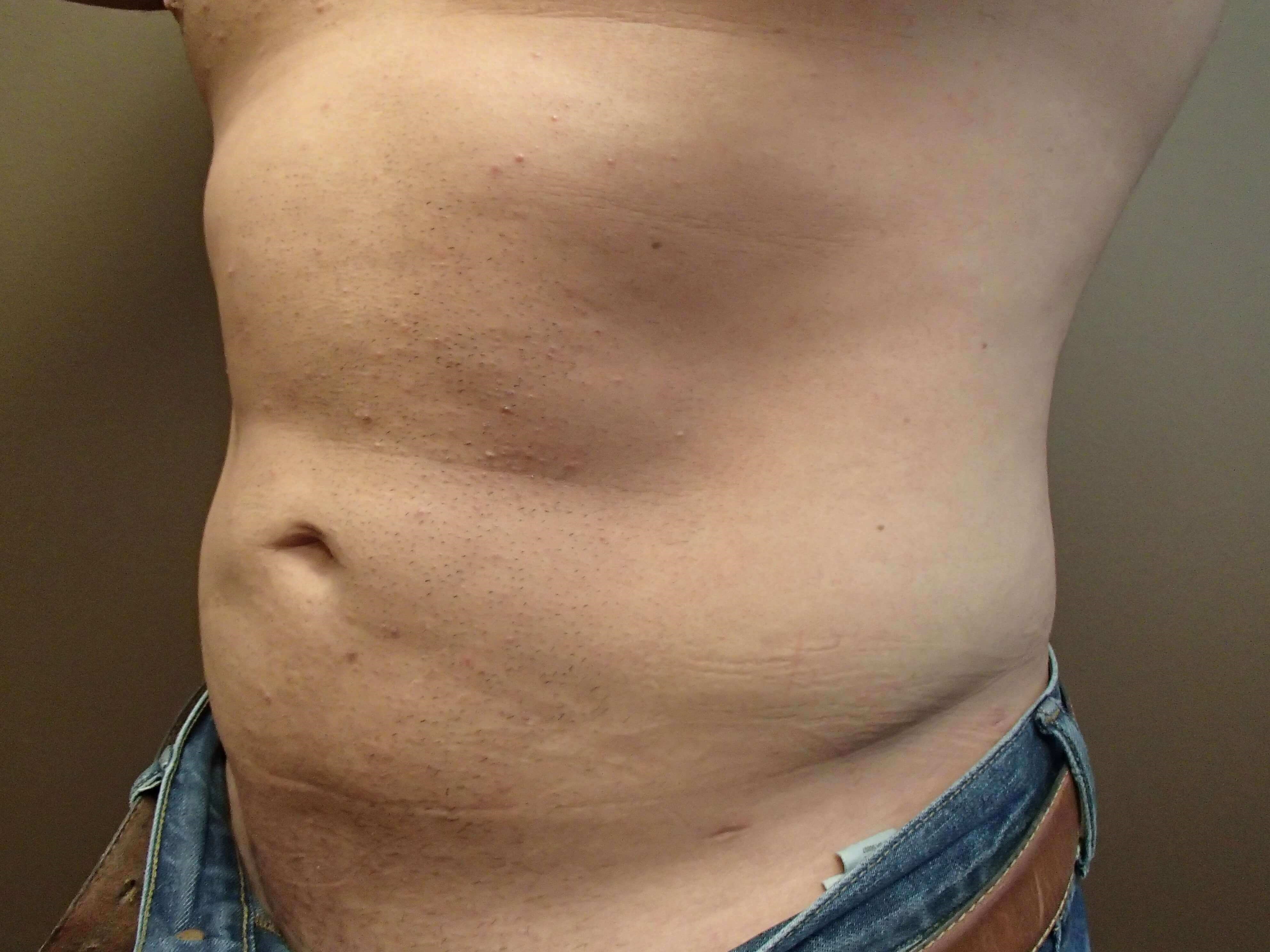 Liposuction After