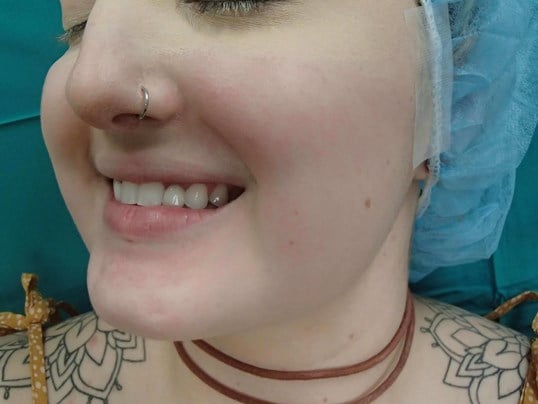 Timeless Dimple (Dimpleplasty) Before