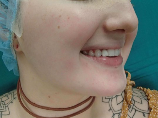 Timeless Dimple (Dimpleplasty) Before
