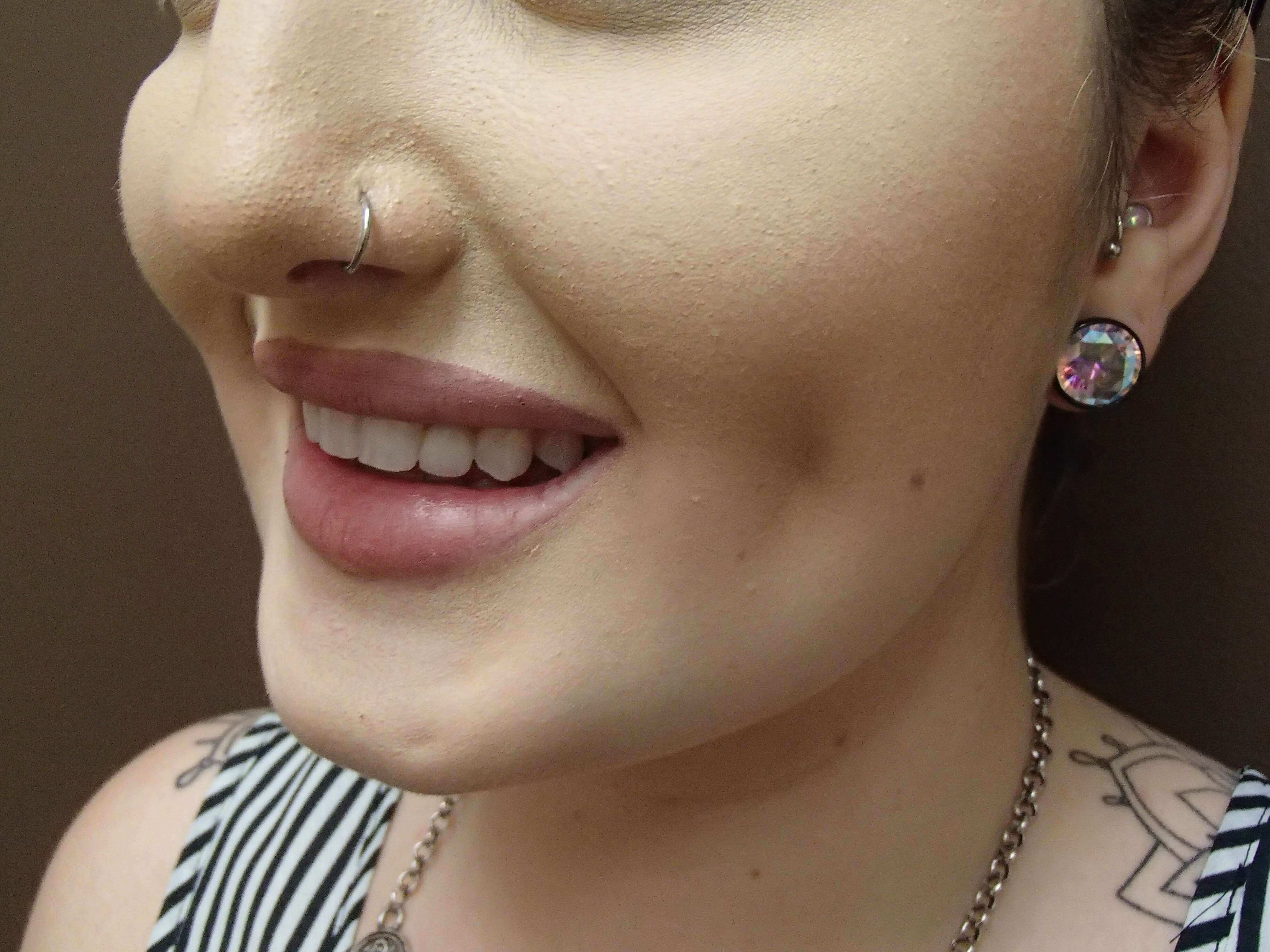 Timeless Dimple (Dimpleplasty) After