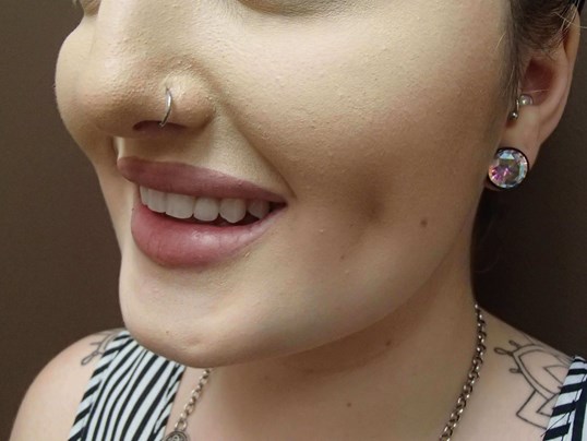 Timeless Dimple (Dimpleplasty) After
