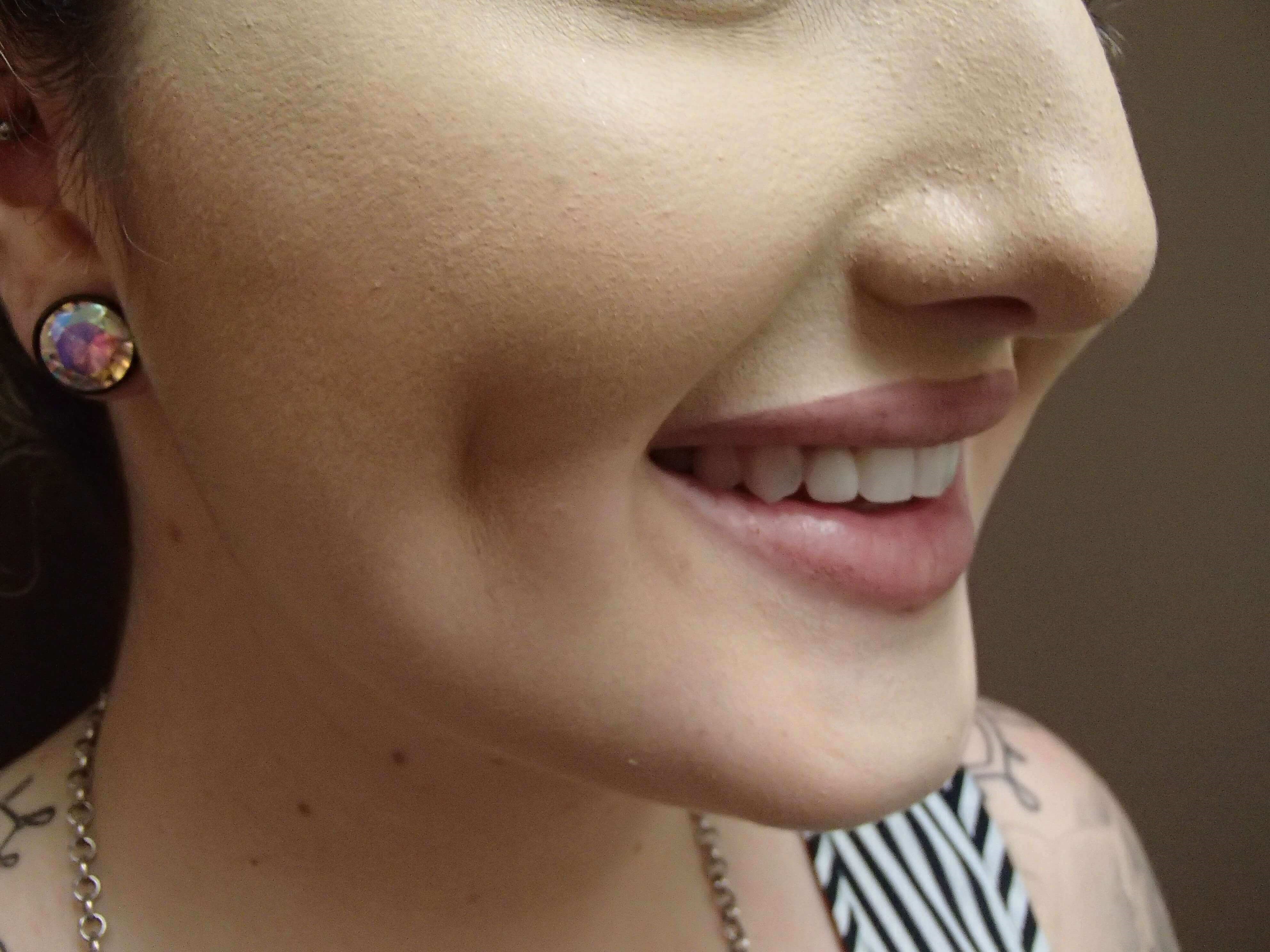Timeless Dimple (Dimpleplasty) After