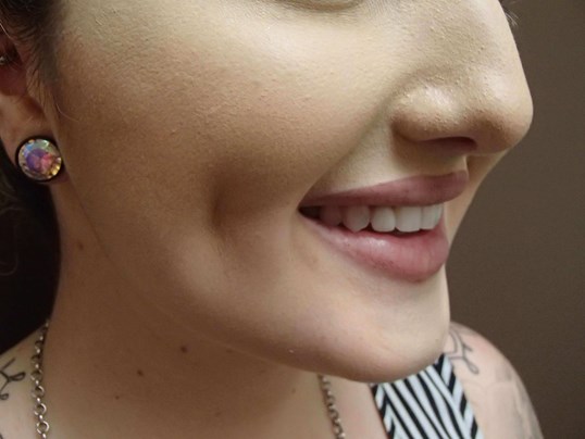 Timeless Dimple (Dimpleplasty) After