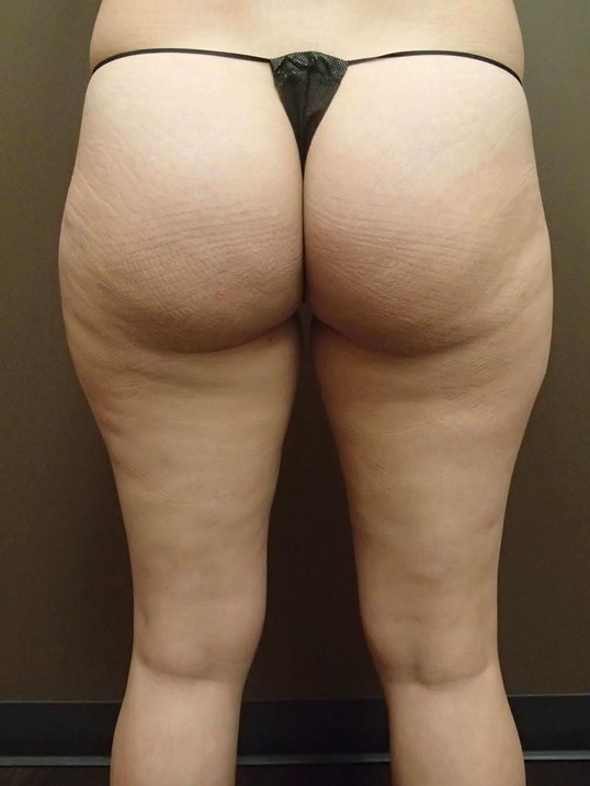 Liposuction Before