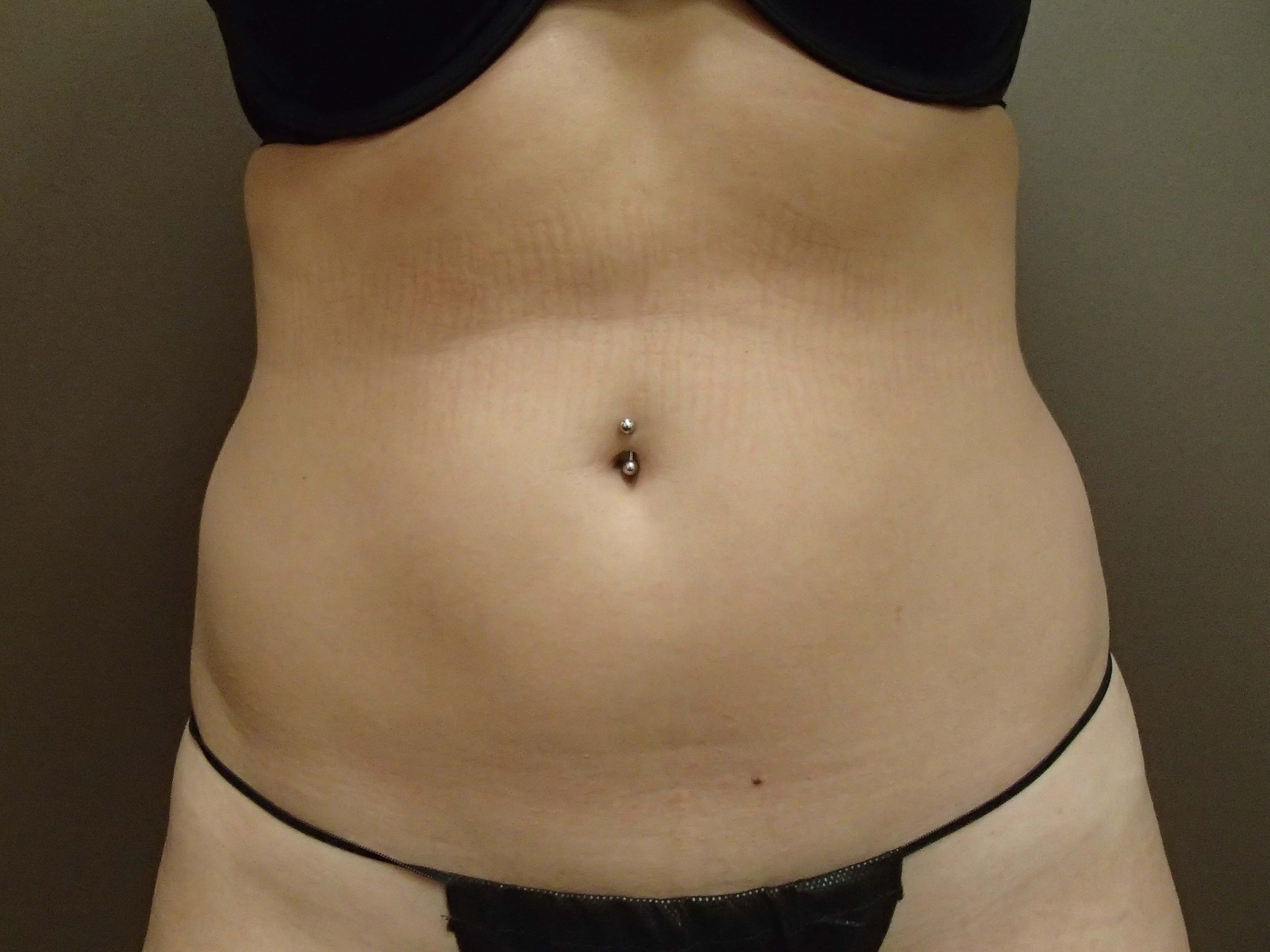 Liposuction Before