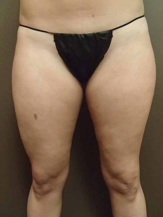 Liposuction Before