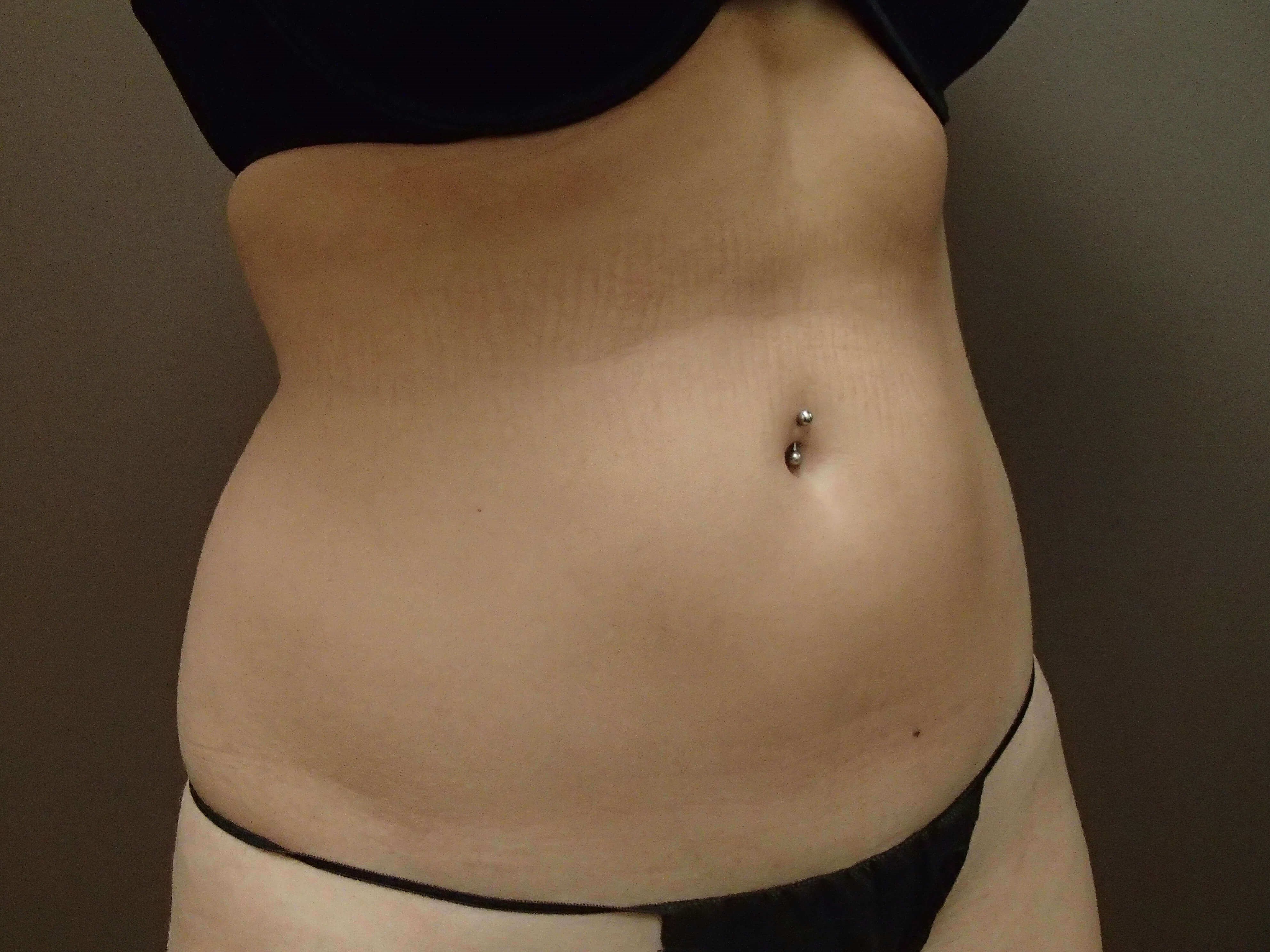 Liposuction Before