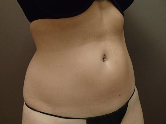 Liposuction Before