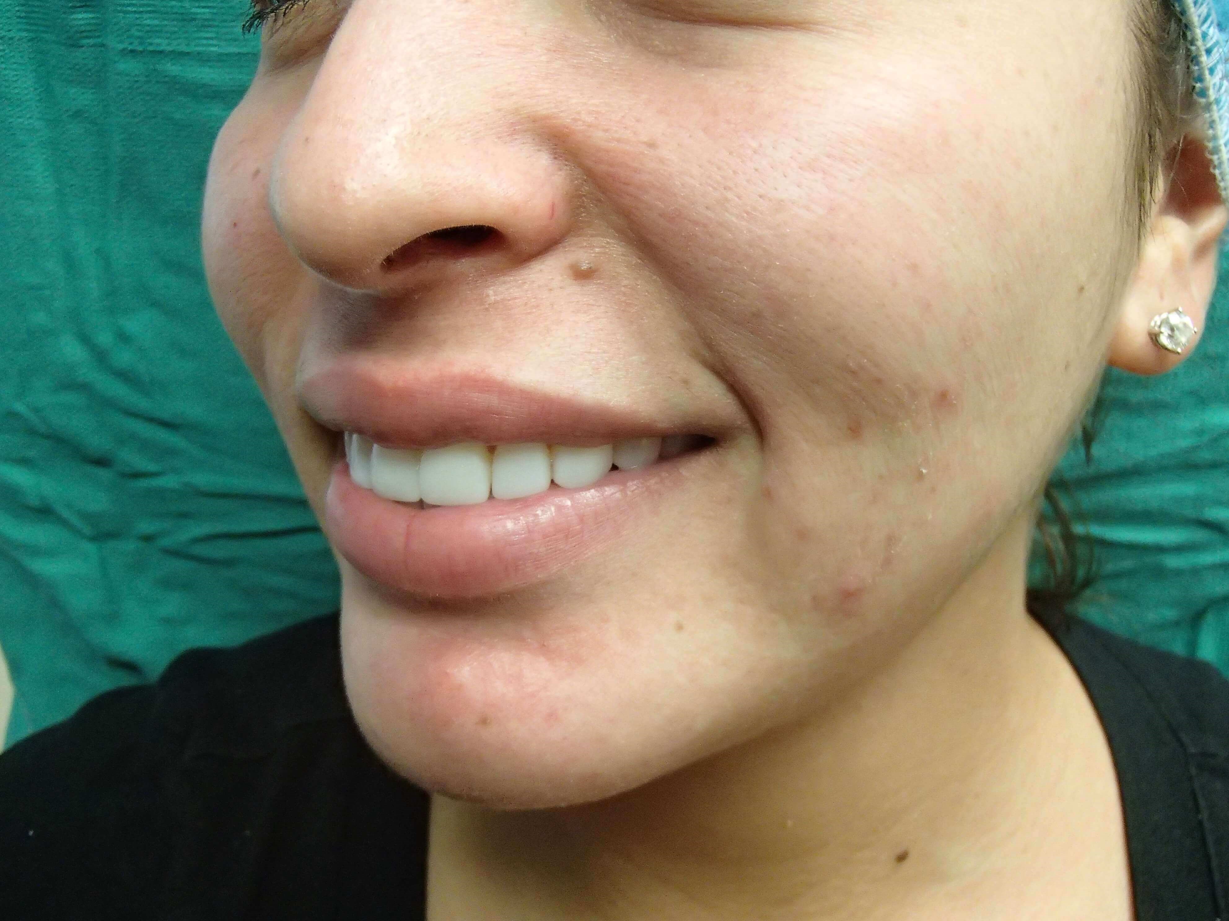 Timeless Dimple (Dimpleplasty) Before