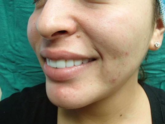Timeless Dimple (Dimpleplasty) Before