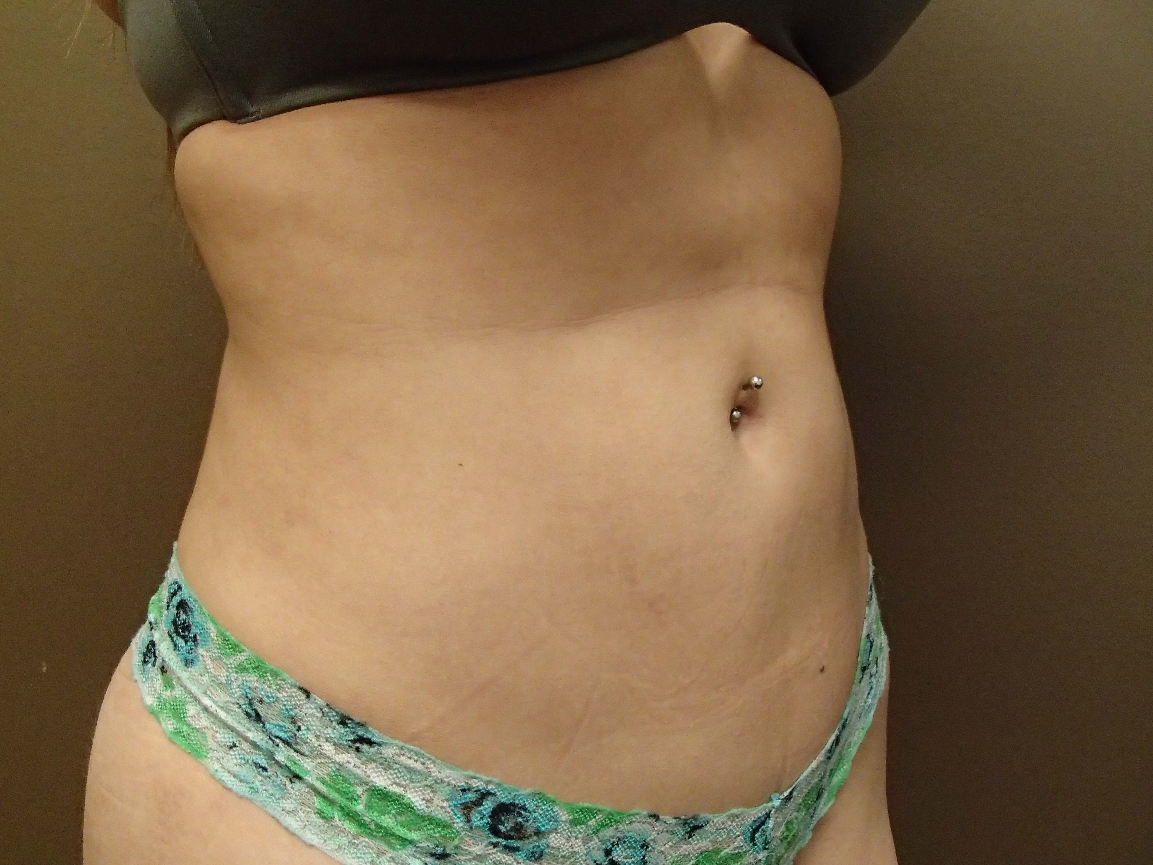 Liposuction After