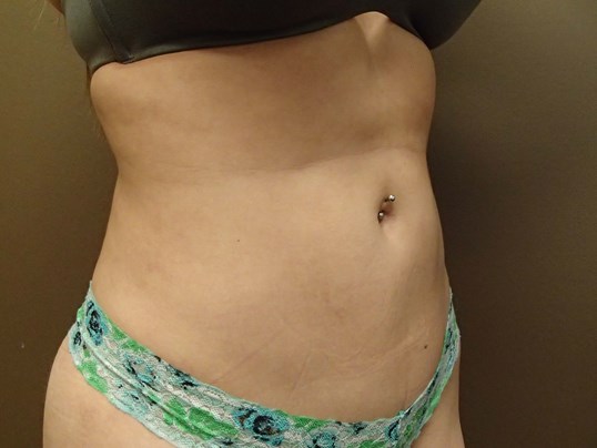 Liposuction After