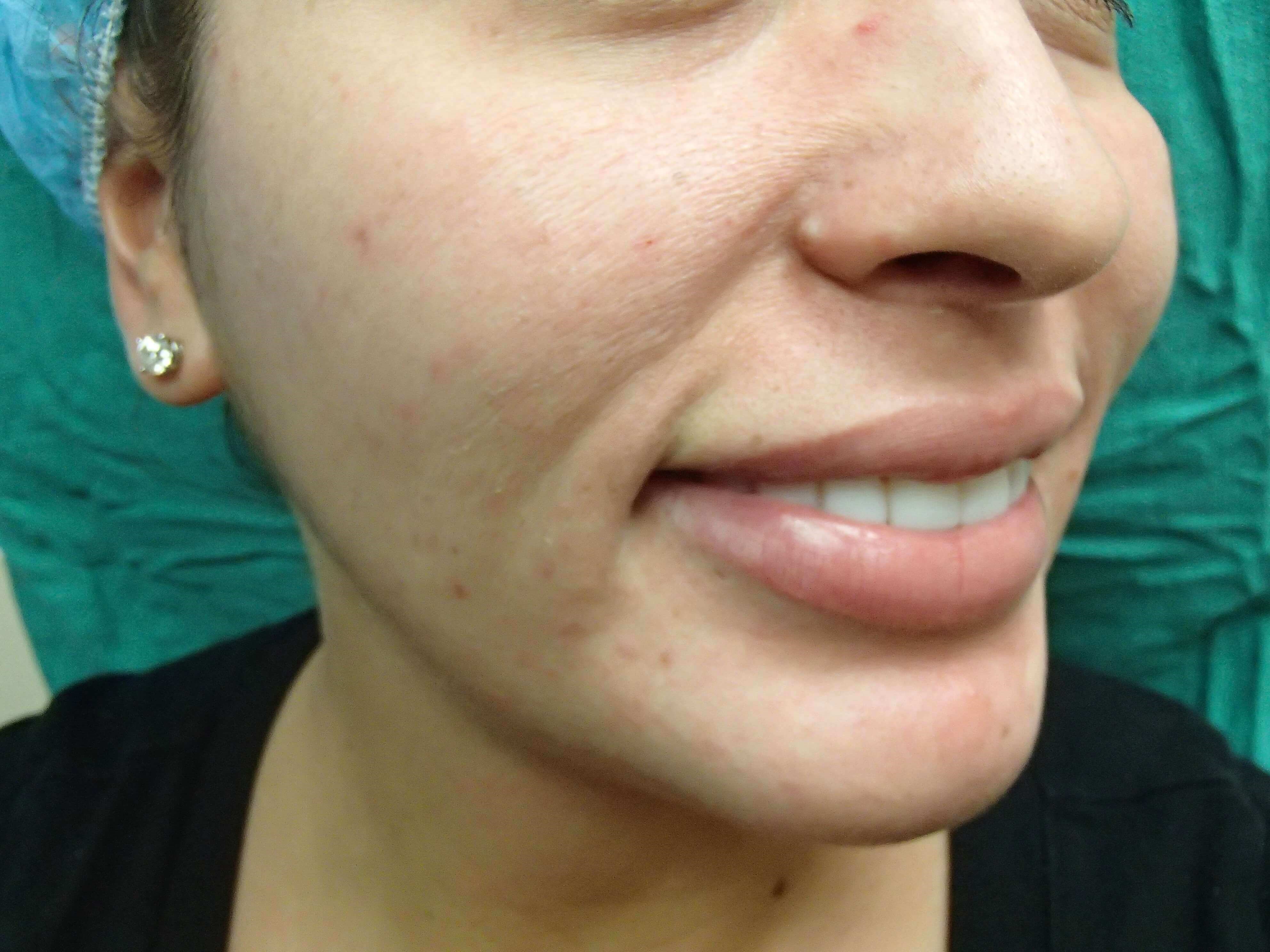Timeless Dimple (Dimpleplasty) Before