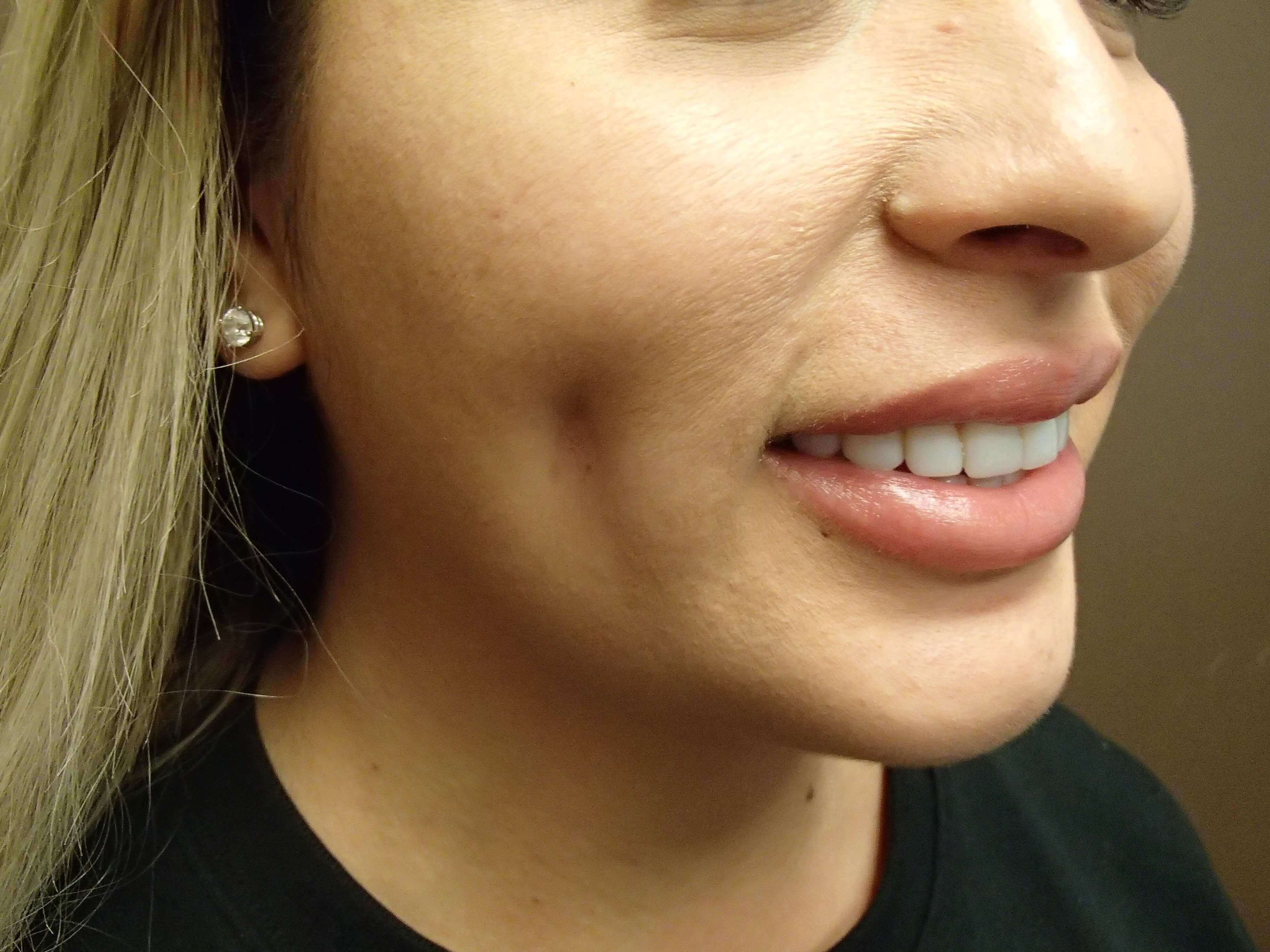 Timeless Dimple (Dimpleplasty) After