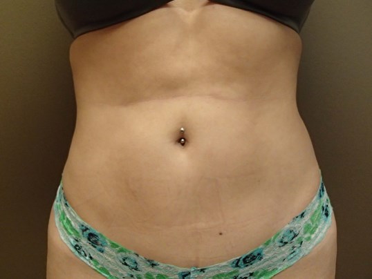 Liposuction After