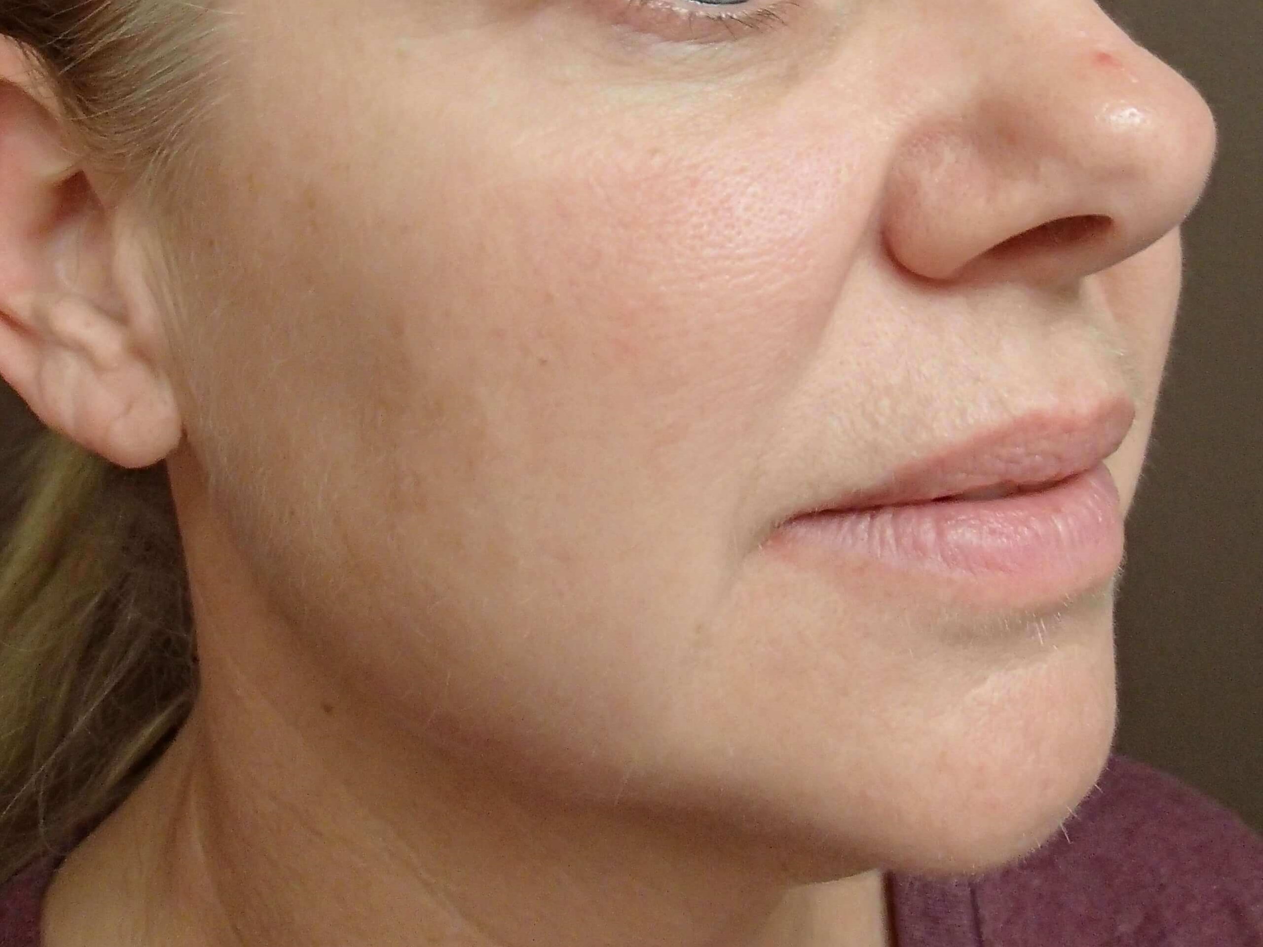 Laser Skin Resurfacing Before