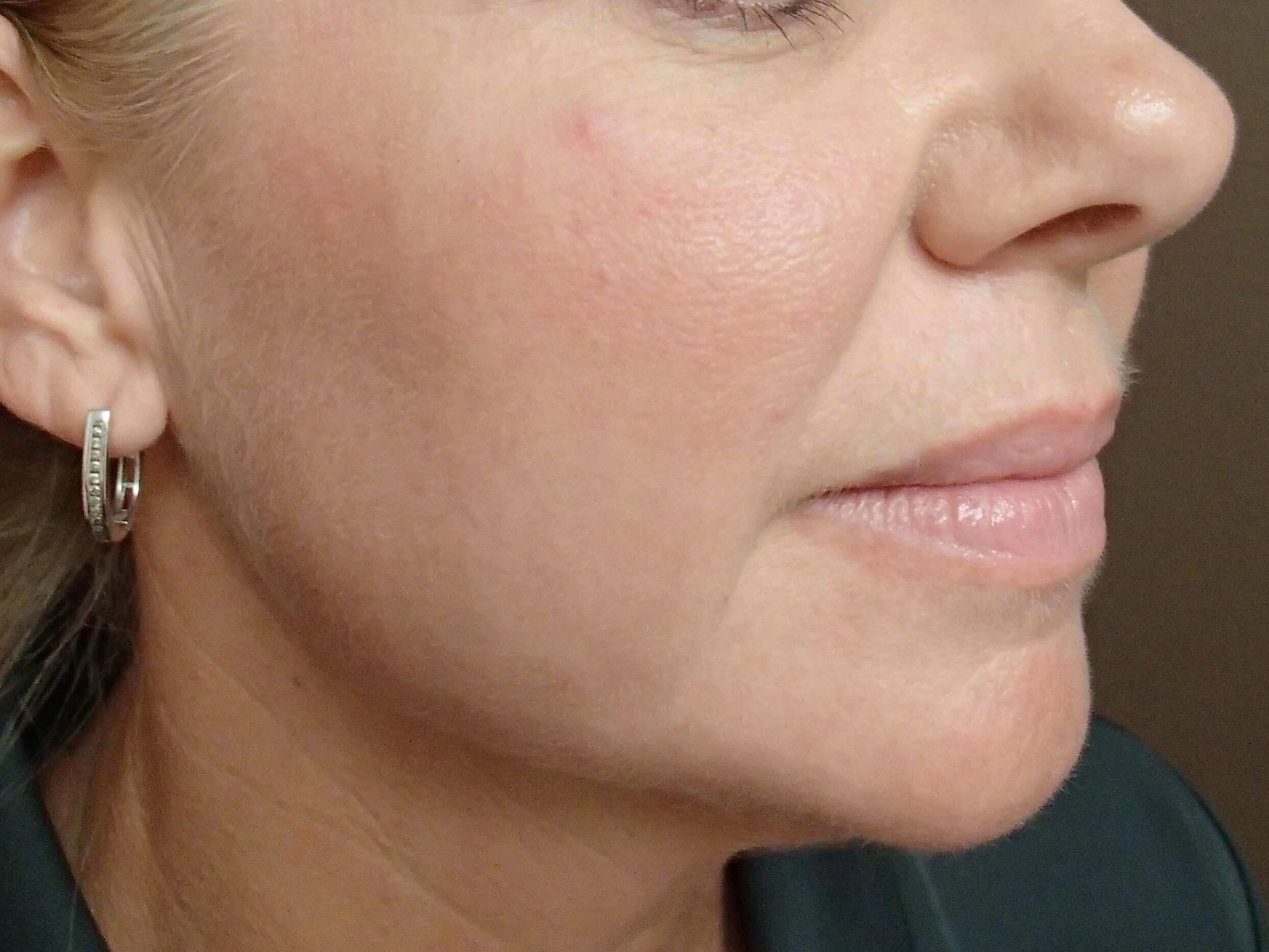 Laser Skin Resurfacing After