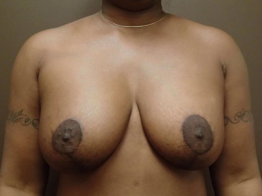 Breast Lift with Implant After