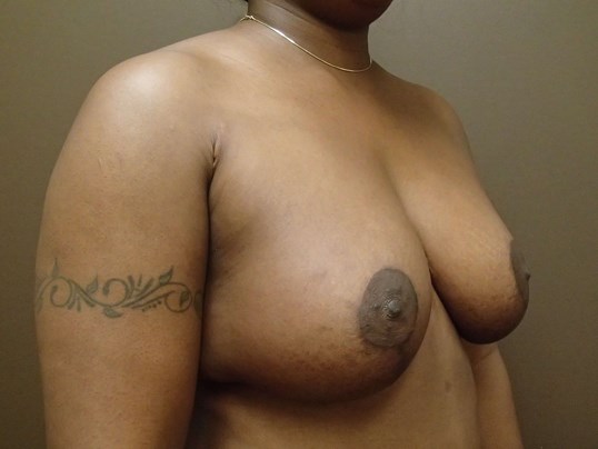 Breast Lift with Implant After
