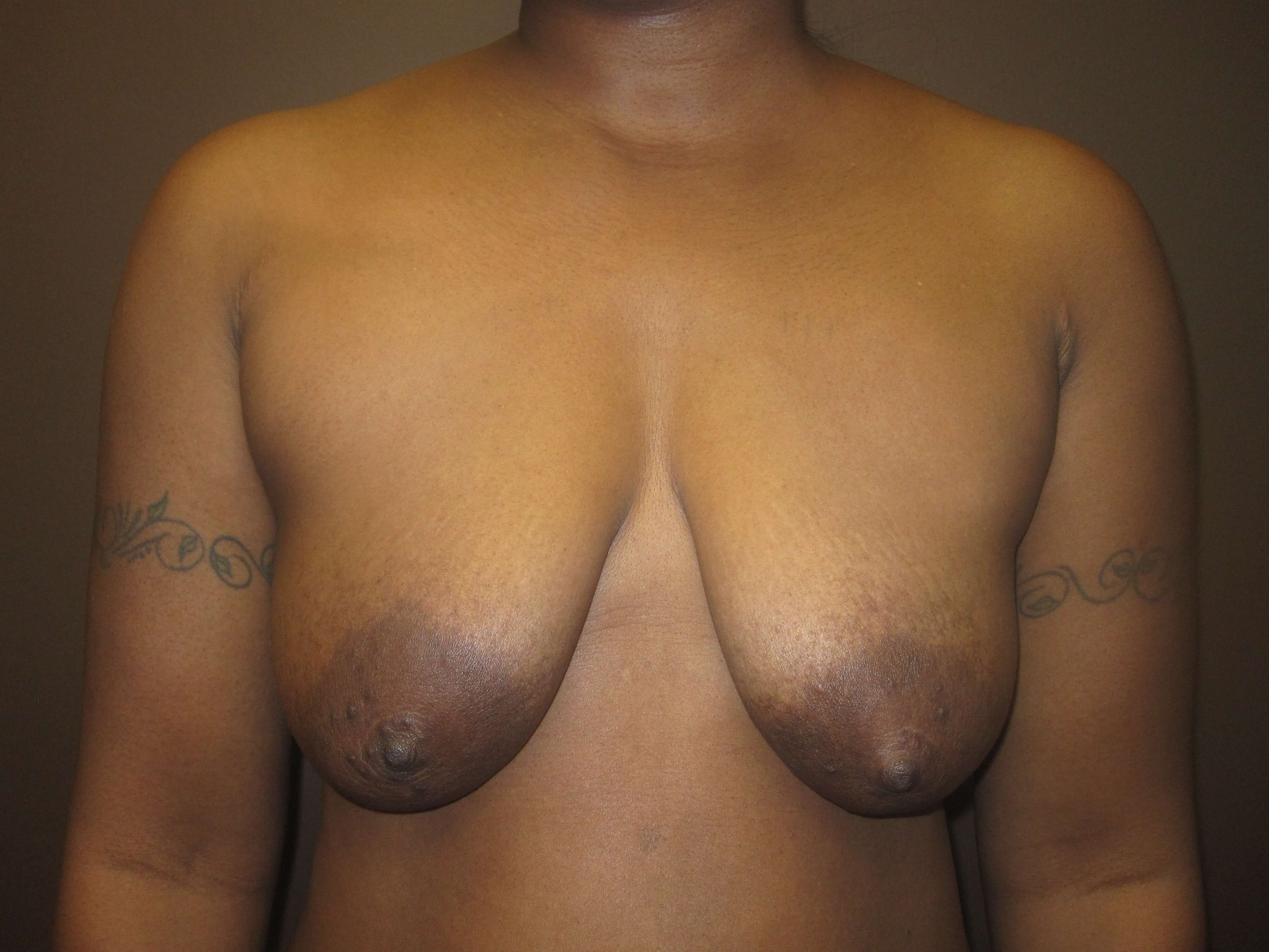 Breast Lift with Implant Before