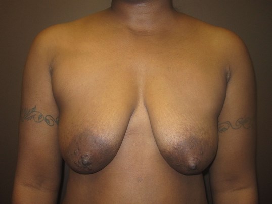 Breast Lift with Implant Before