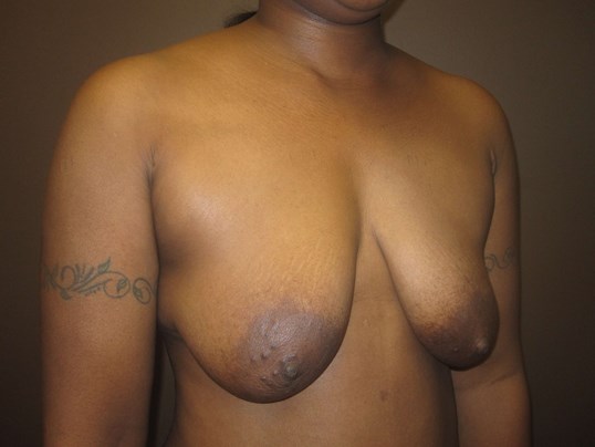 Breast Lift with Implant Before