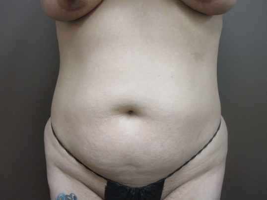 Liposuction Before