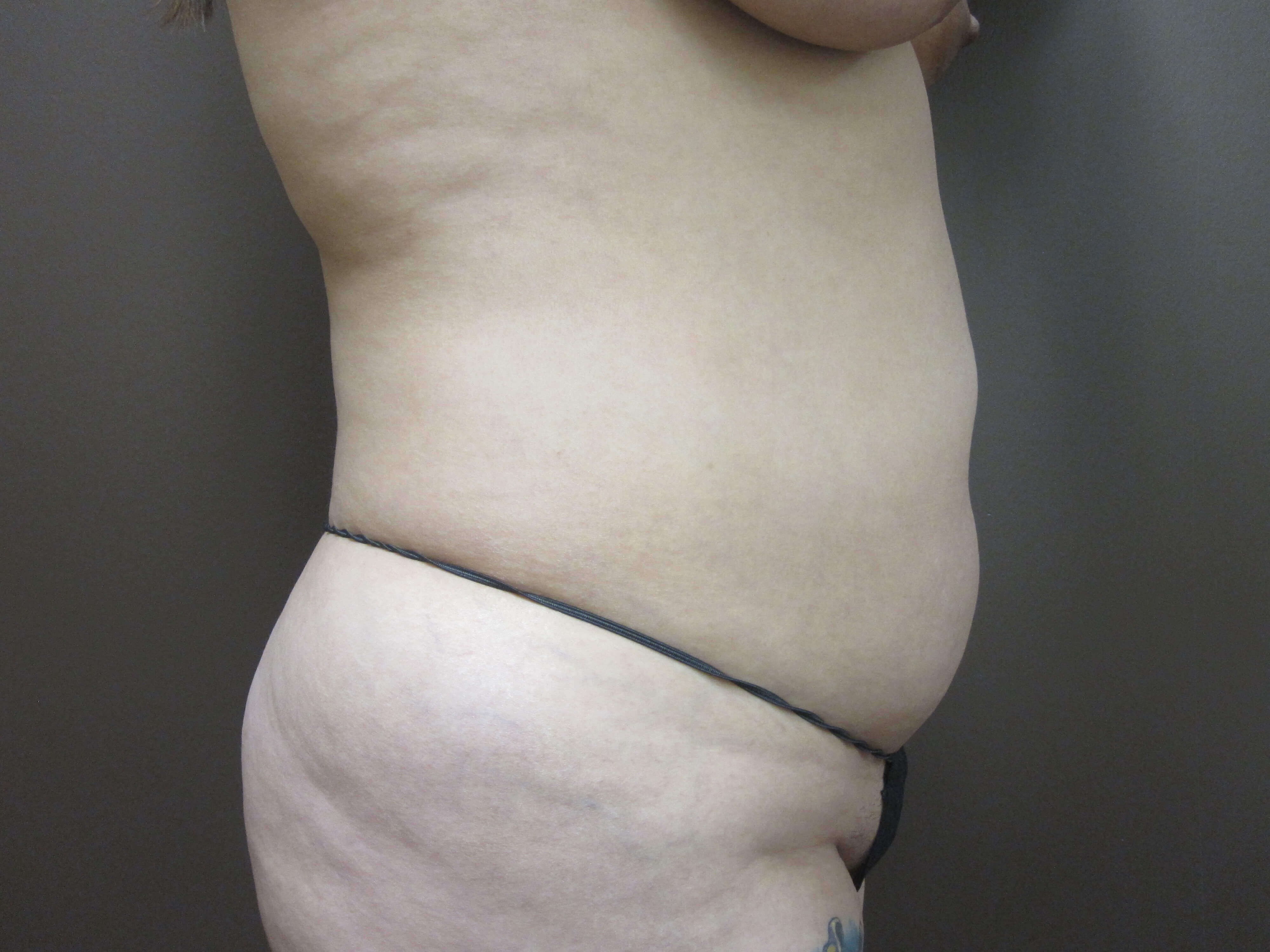 Liposuction Before