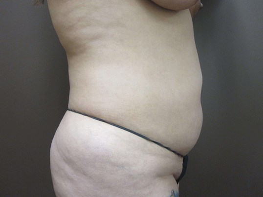 Liposuction Before